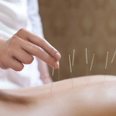 The Magic of Acupuncture
