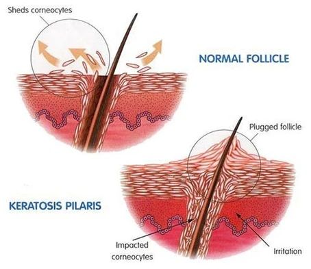 Keratosis Pilaris