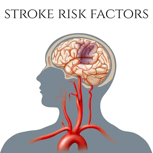 More Subtle Stroke Risks Explained