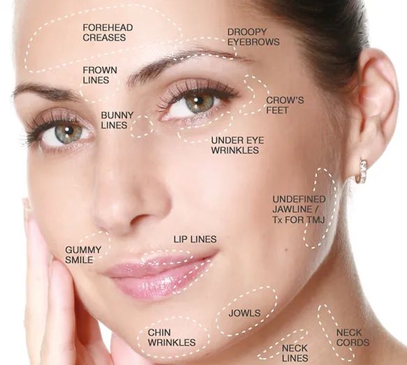 Botulinum Toxin a (Botox, Xeomin)