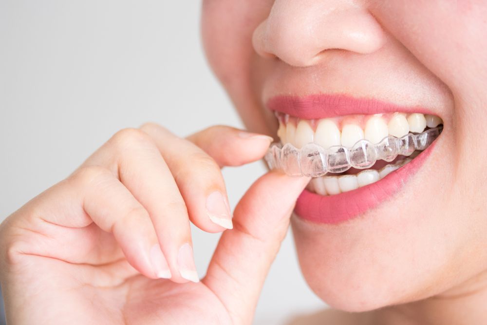 5 Reasons to Choose Invisalign to Straighten Teeth