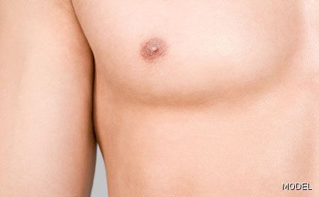 male breast reduction