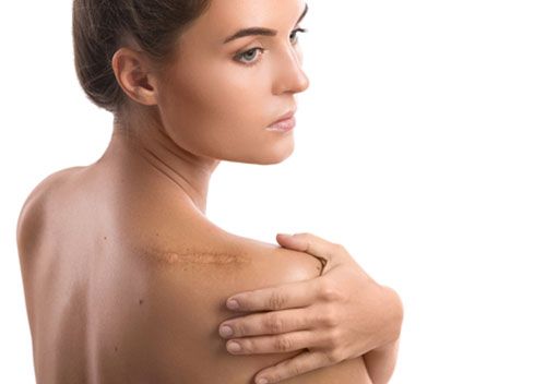 Scar Revision