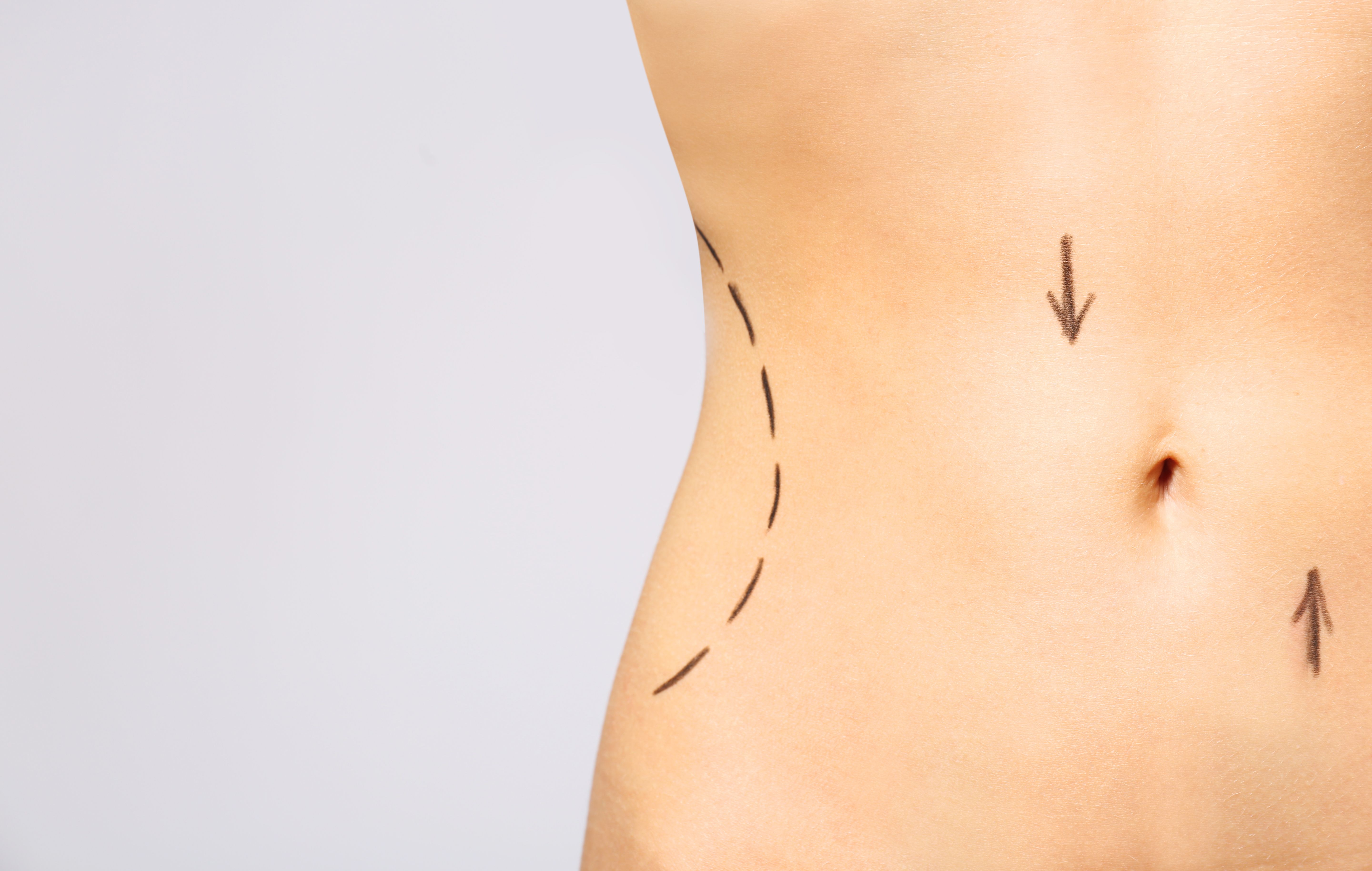 body contouring