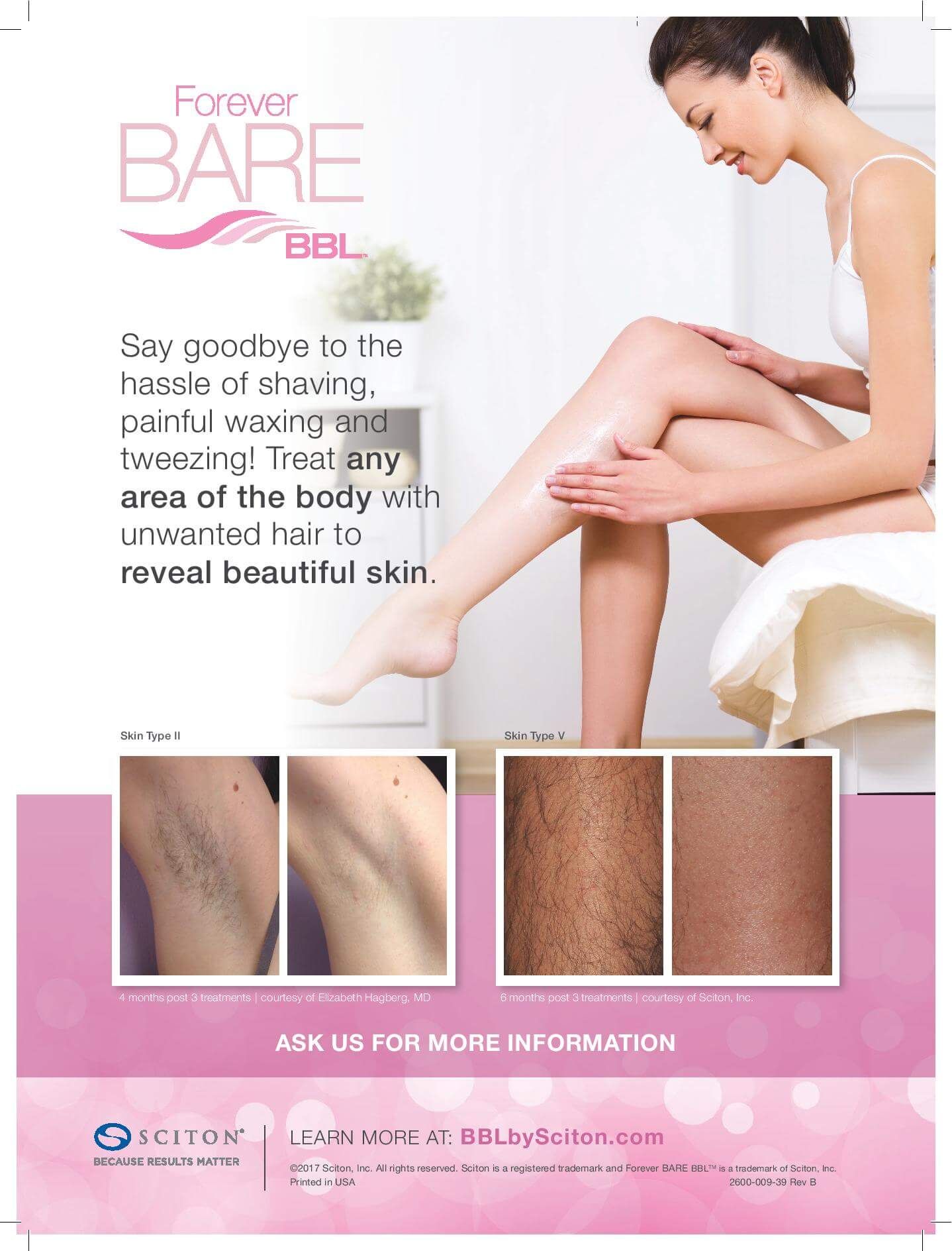 laser hair removal