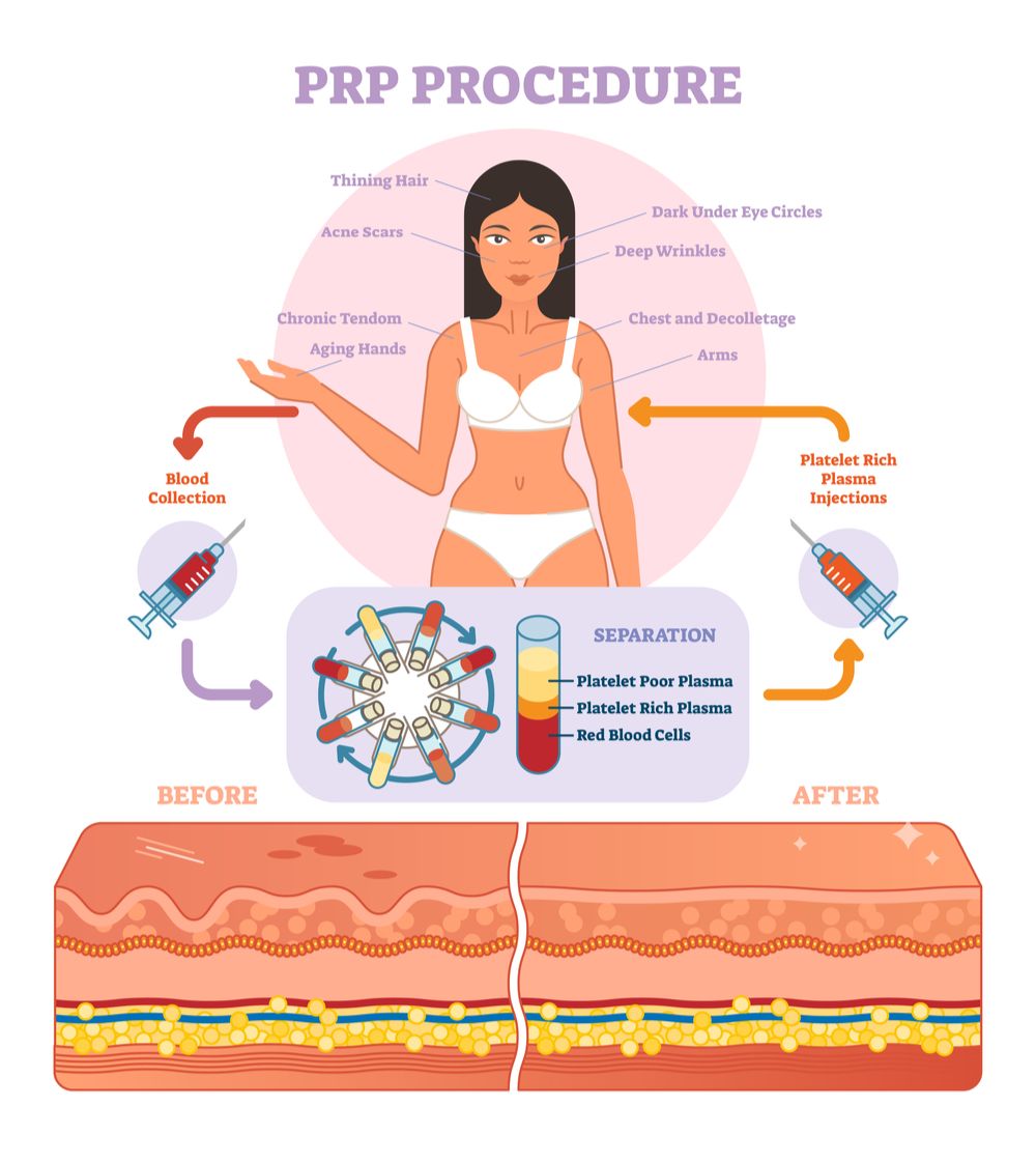 topical prp