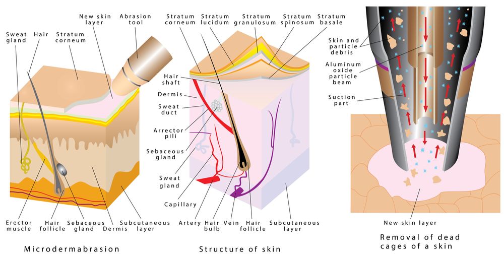 microdermabrasion