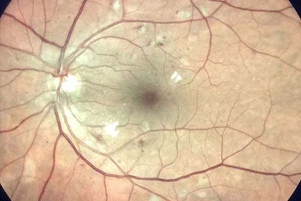 Diabetic Retinopathy