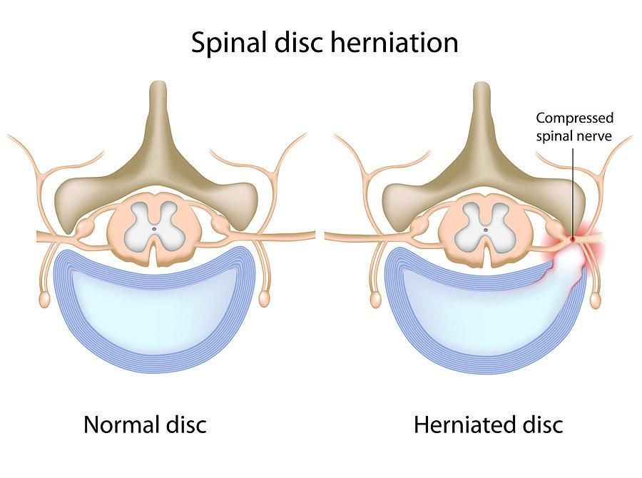 How To Know If You Are Experiencing Disc Herniation