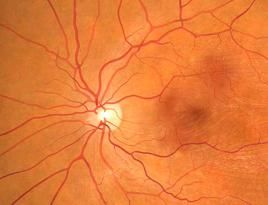 treating macular degeneration