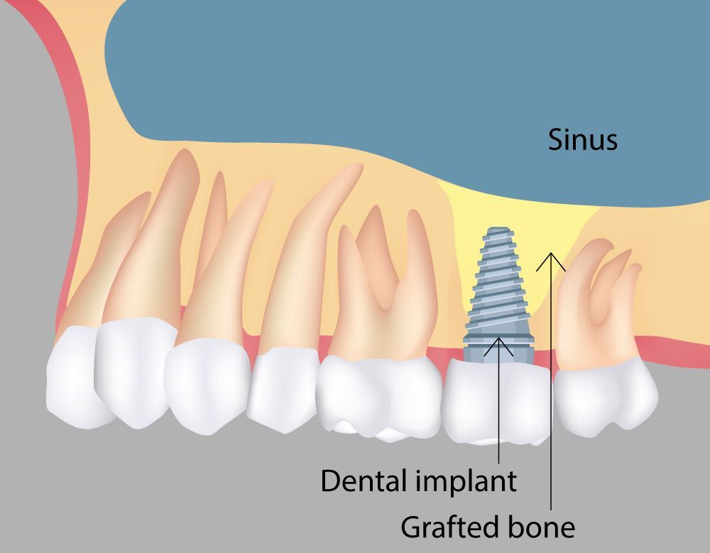 Sinus