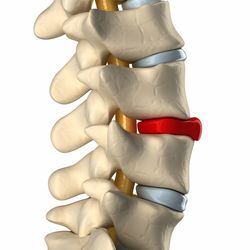 degenerative disc disease