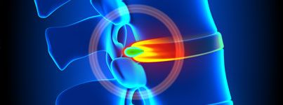 herniated disc