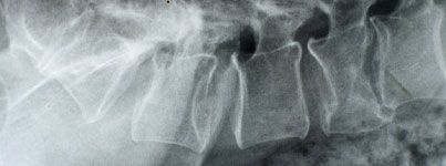 spinal fractures
