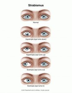 Strabismus