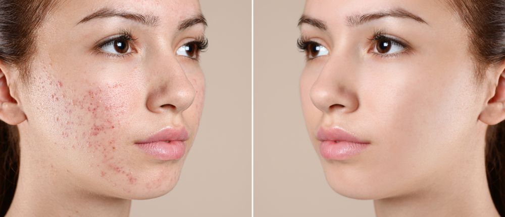 Microdermabrasion for Acne Scars: How it Helps Fade Blemishes and Smooth Skin