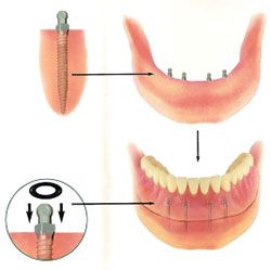 implant dentures