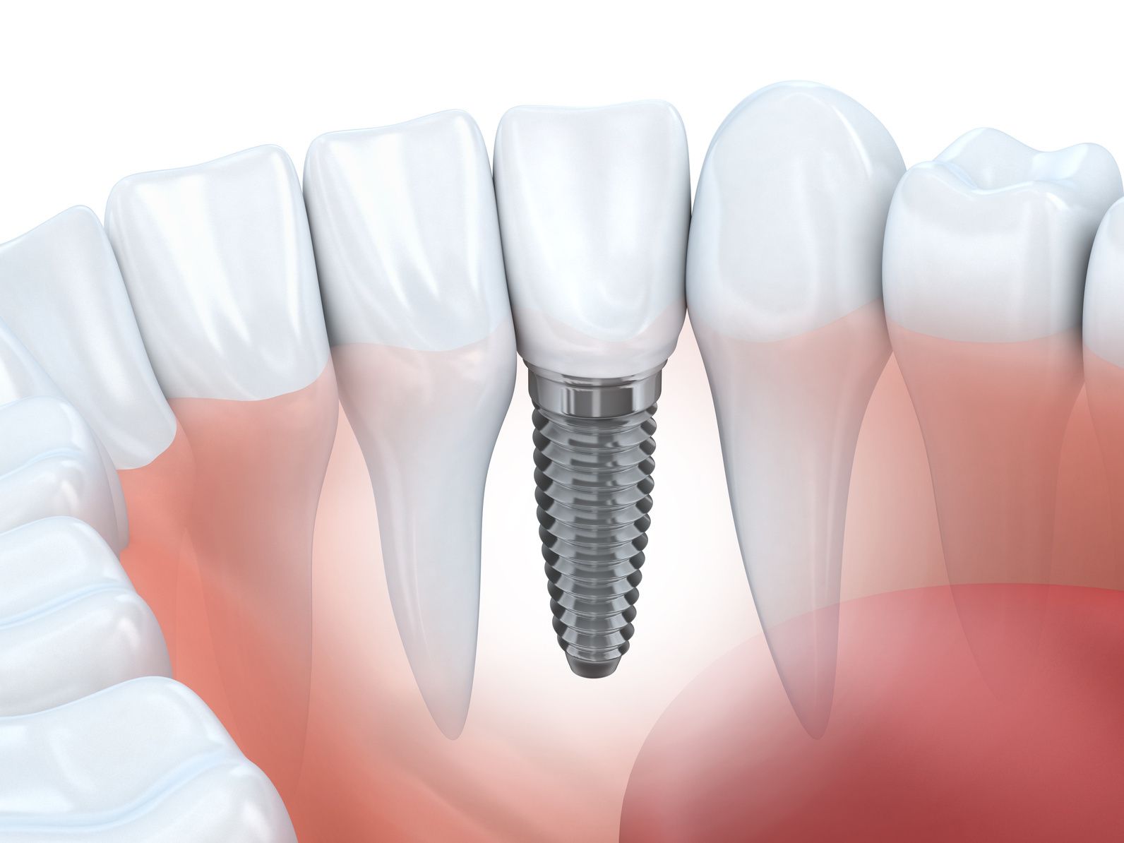 Implanted Teeth​​​​​​​