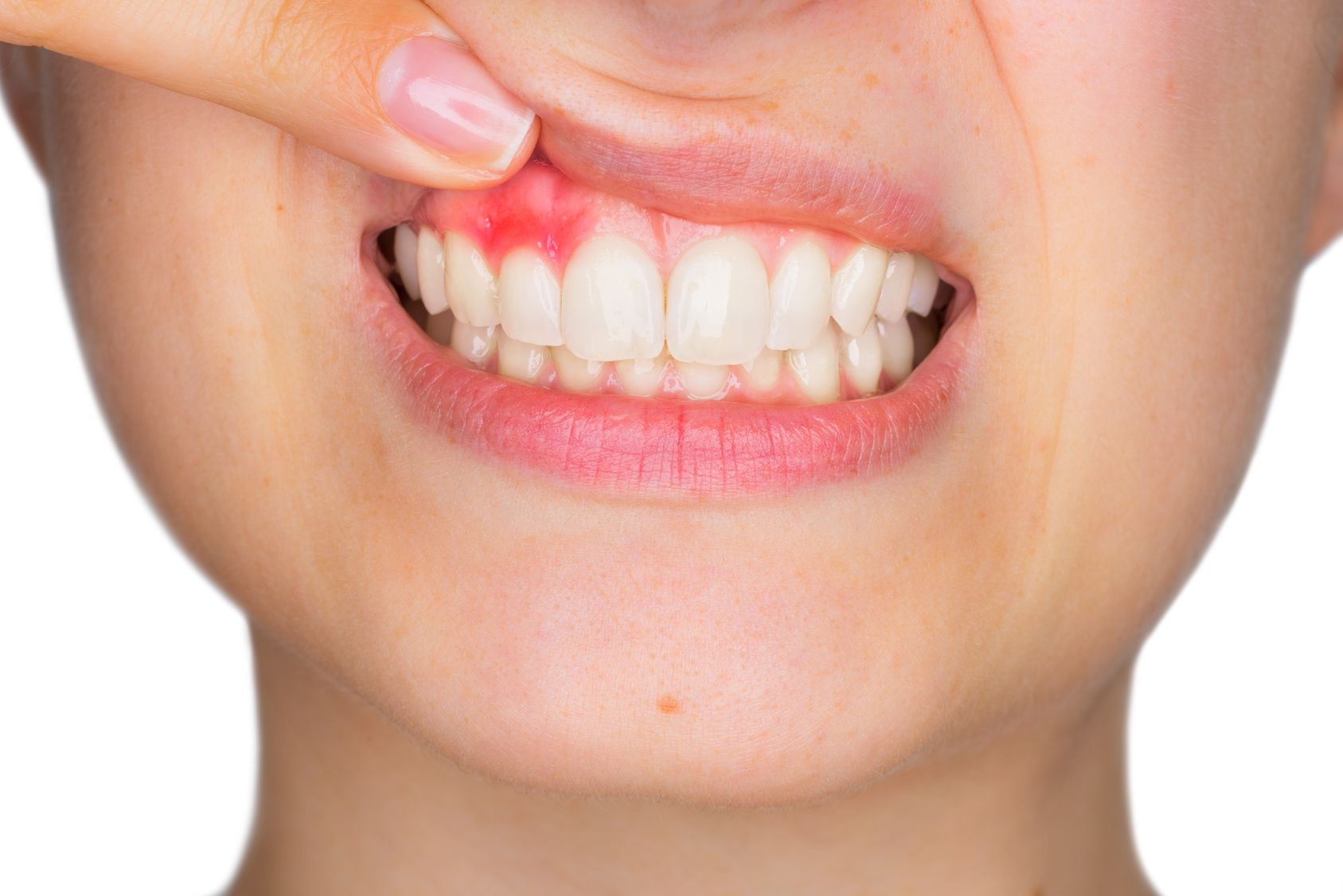 Lady with Gum Problem
