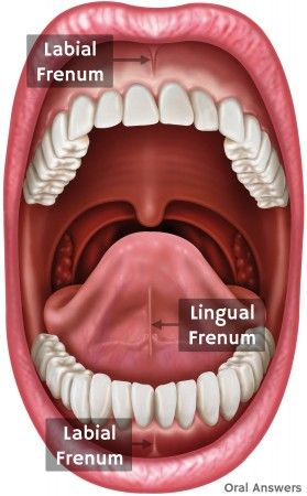 frenectomy