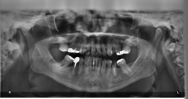 Dental x-rays