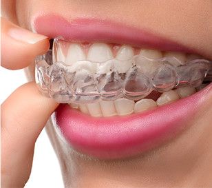 Superfast Invisalign