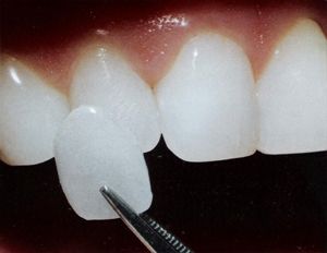 porcelain veneers