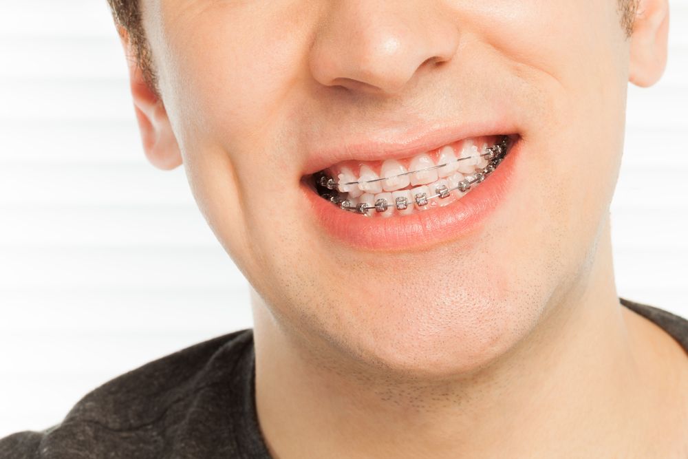 smiling man with braces​​​​​​​