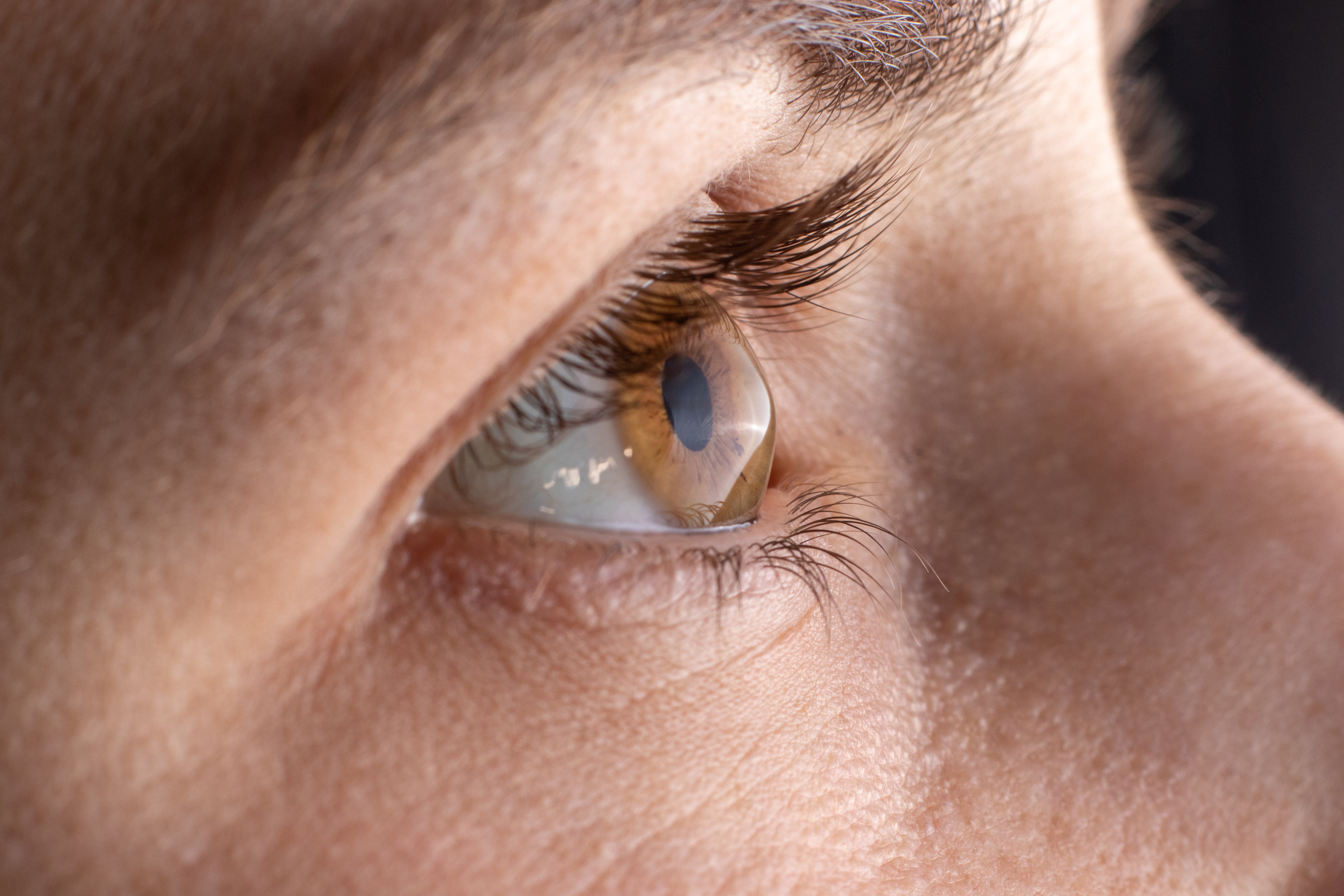 What is keratoconus and how is it treated?