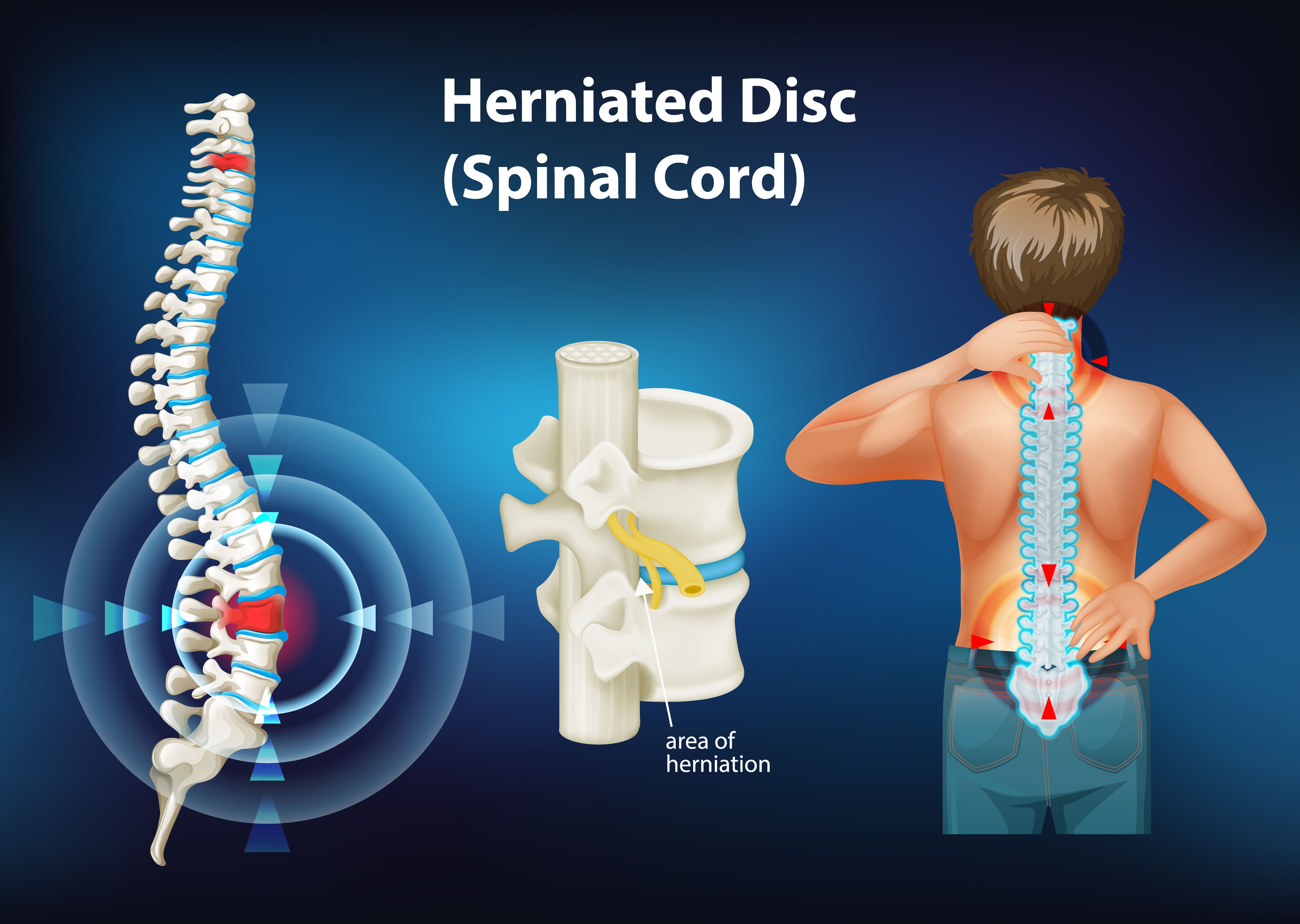Navigating Relief from Disc Herniation with Chiropractic Care in Keller