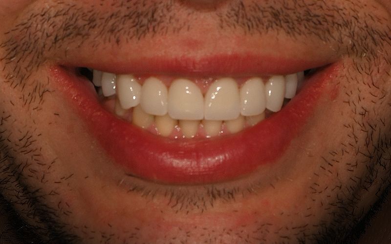 before and after