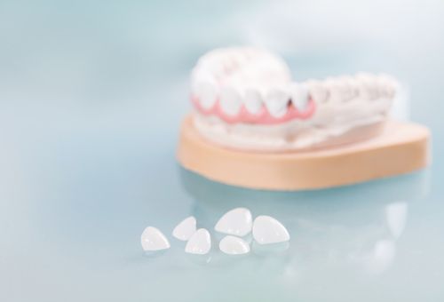 veneers