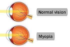 What causes myopia?