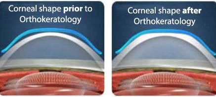 What is orthokeratology (ortho-k)?