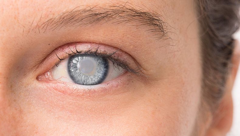 Cataracts