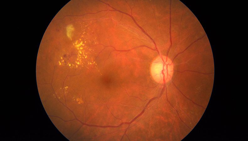 Macular Degeneration