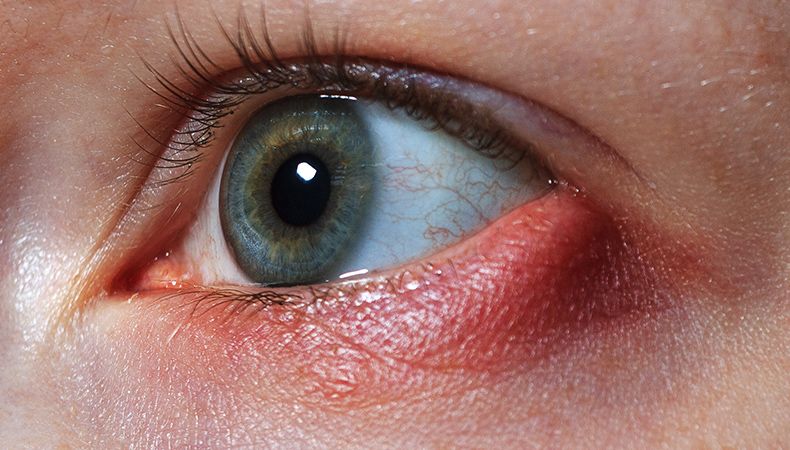 Stye Treatment