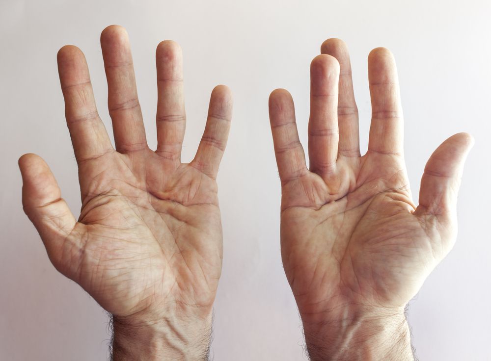 Dupuytren's Disease