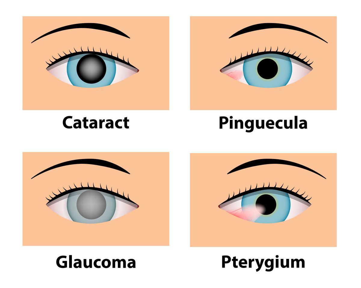 How UV rays can damage eyes