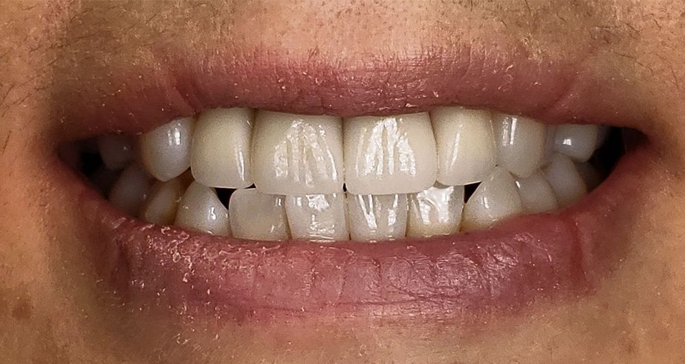 after veneers