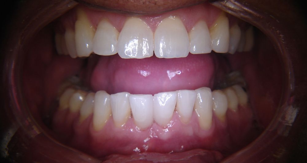 after veneers