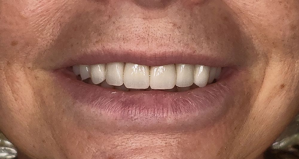 after veneers