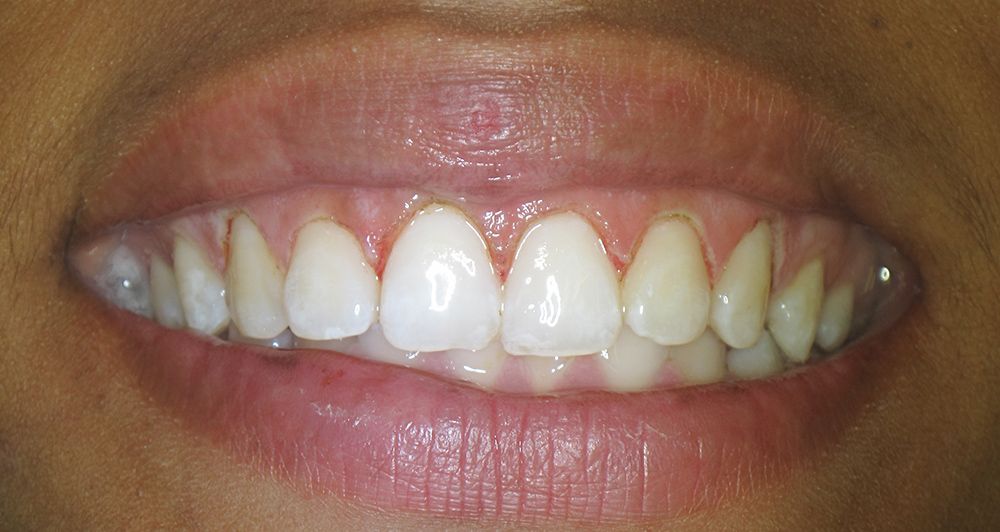 after veneers