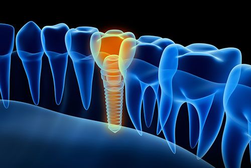 dental implant 