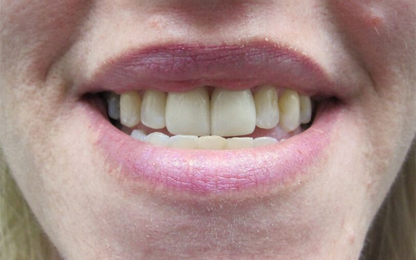 after veneers