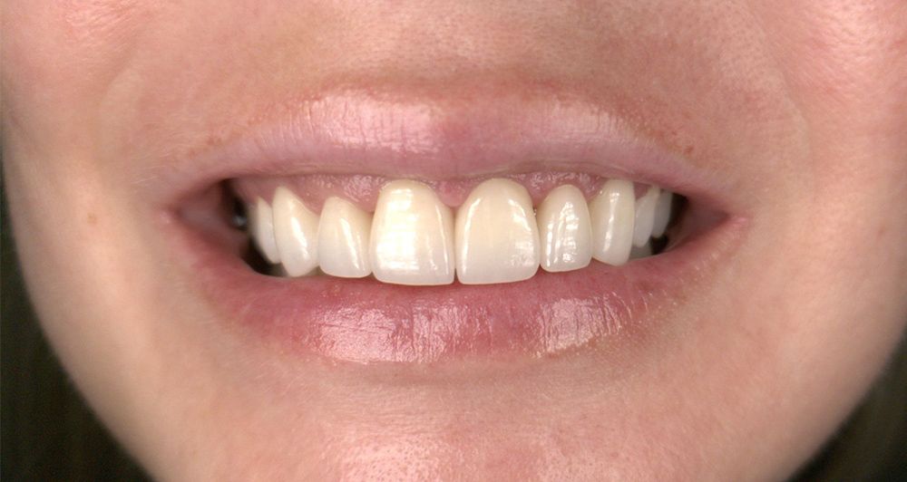 after veneers