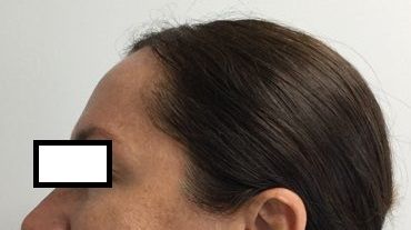 Botox After Treatment