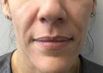 Fillers Before