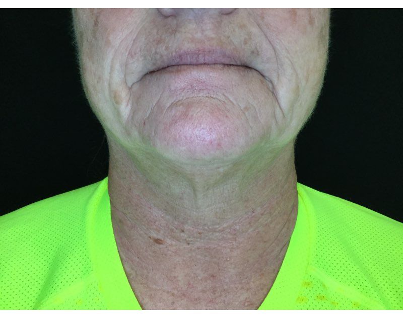 Botox After Treatment