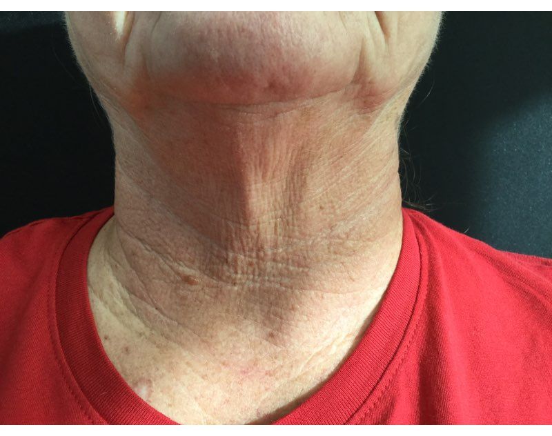 Before Botox Treatment